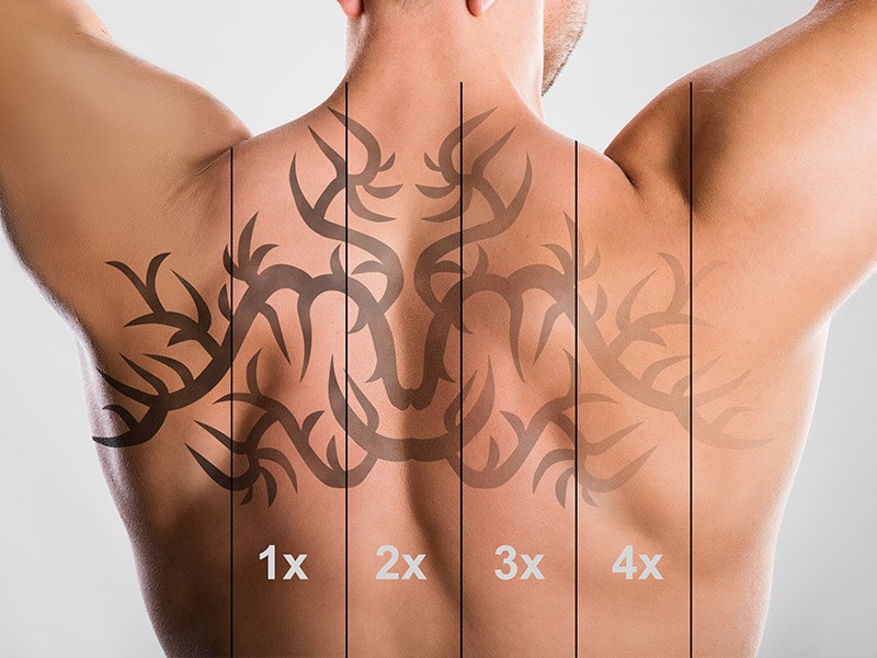 Is a Laser Tattoo Removal Course for me? - AACDS Cosmetic Dermal Science  courses | Online